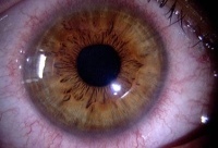 vaskularizace zarudnutí očí